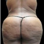 Female Liposuction Before & After Patient #863