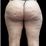 Female Liposuction Before & After Patient #868