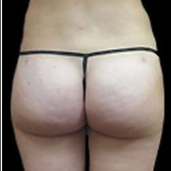 Female Liposuction Before & After Patient #877