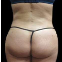 Female Liposuction Before & After Patient #880