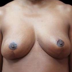 Liposuction and Breast Reduction Before & After Patient #639