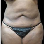 Female Liposuction Before & After Patient #887