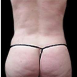 Female Liposuction Before & After Patient #894