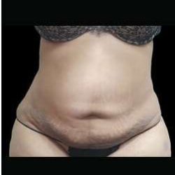 Female Liposuction Before & After Patient #899