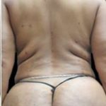 Female Liposuction Before & After Patient #908