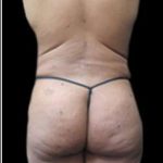Female Liposuction Before & After Patient #915