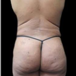 Female Liposuction Before & After Patient #915