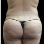 Female Liposuction Before & After Patient #918