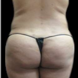 Female Liposuction Before & After Patient #918