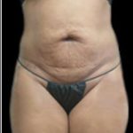 Female Liposuction Before & After Patient #923