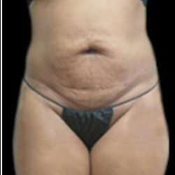 Female Liposuction Before & After Patient #923