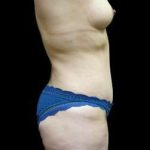Female Liposuction Before & After Patient #930