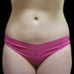 Female Liposuction Before & After Patient #948