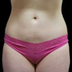 Female Liposuction Before & After Patient #948