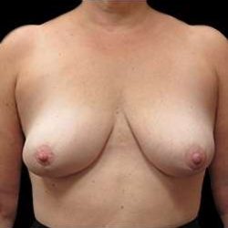 Liposuction and Breast Reduction Before & After Patient #650