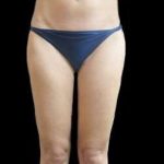 Female Liposuction Before & After Patient #953