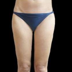 Female Liposuction Before & After Patient #953