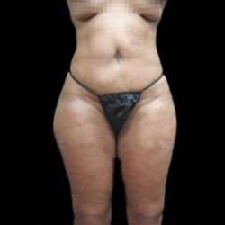 Female Liposuction Before & After Patient #960