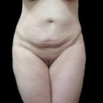 Female Liposuction Before & After Patient #967