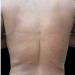 Female Liposuction Before & After Patient #970