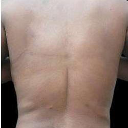 Female Liposuction Before & After Patient #970