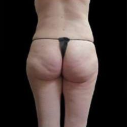 Female Liposuction Before & After Patient #978