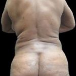 Female Liposuction Before & After Patient #981