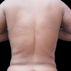 Female Liposuction Before & After Patient #986