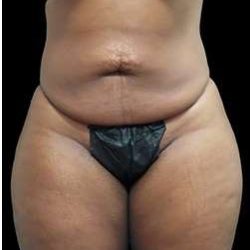 Female Liposuction Before & After Patient #995