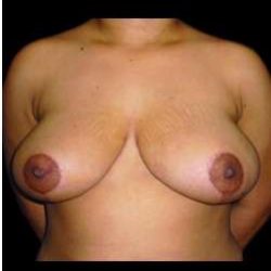 Liposuction and Breast Reduction Before & After Patient #661