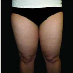 Female Liposuction Before & After Patient #1019