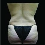 Female Liposuction Before & After Patient #1022