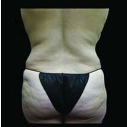 Female Liposuction Before & After Patient #1022