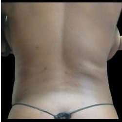 Female Liposuction Before & After Patient #1025