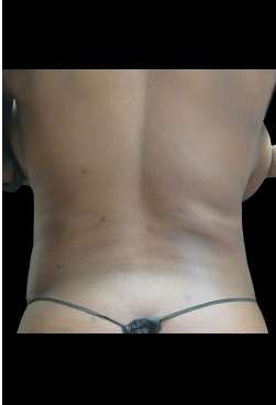 Female Liposuction Before & After Patient #1025