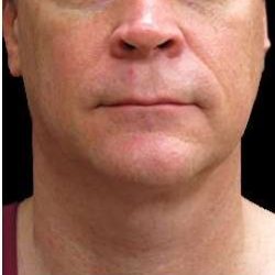 Male Liposuction Before & After Patient #1032