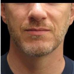 Male Liposuction Before & After Patient #1039