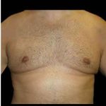 Male Liposuction Before & After Patient #1057