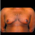 Male Liposuction Before & After Patient #1064
