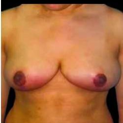 Liposuction and Breast Reduction Before & After Patient #672