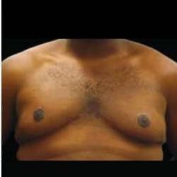 Male Liposuction Before & After Patient #1071