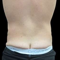 Male Liposuction Before & After Patient #1080