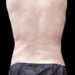Male Liposuction Before & After Patient #1089