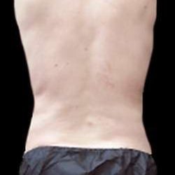 Male Liposuction Before & After Patient #1089