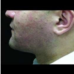 Male Liposuction Before & After Patient #1092