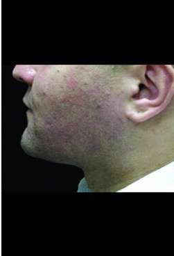 Male Liposuction Before & After Patient #1092