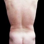 Male Liposuction Before & After Patient #1099