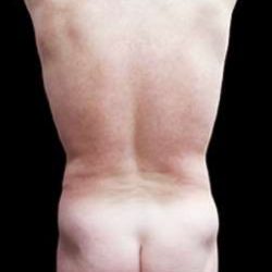 Male Liposuction Before & After Patient #1099