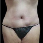 Liposuction and Mommy Makeover Before & After Patient #1112