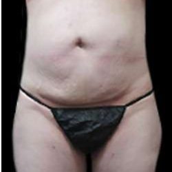Liposuction and Mommy Makeover Before & After Patient #1133